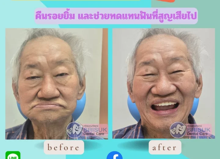 ฟันปลอม