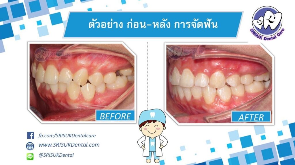 เคสจัดฟัน 1