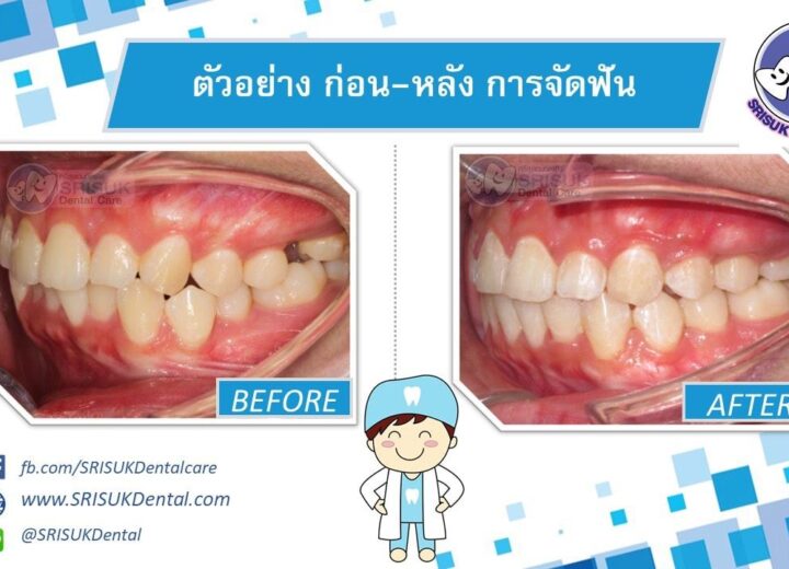 เคสจัดฟัน