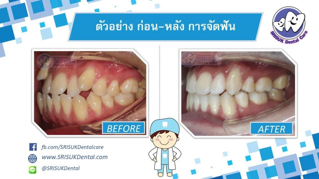 เคสจัดฟัน 3